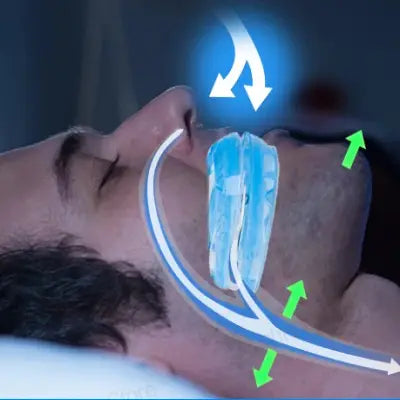 Gouttière Anti Ronflement - AntiSnoringMouthGuard™ - Bleu
